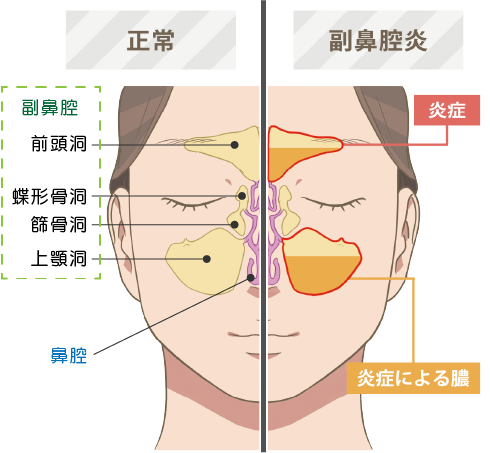 正常な状態と炎症を起こしている副鼻腔の比較解剖図