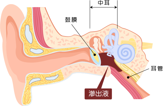 滲出性中耳炎の説明をする耳の解剖図